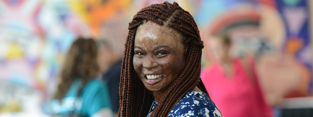 A photo of a female burn survivor smiling