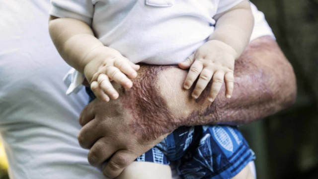 Burn_survivor_client_injuries